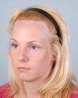 After Hair Transplant&nbsp;Hairline